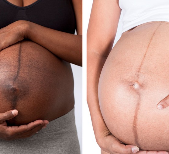 examples of linea nigra in pregnancy