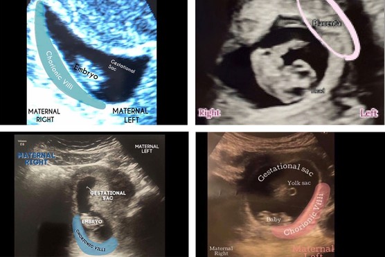 Ramzi Theory: pregnancy ultrasound scans showing boy examples and girl examples
