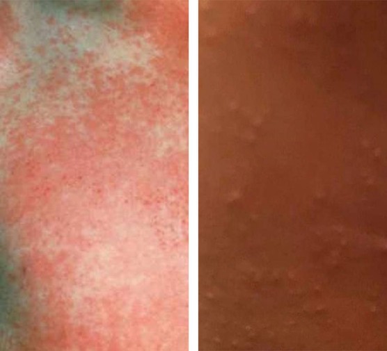 scarlet fever rash on white skin and on black skin